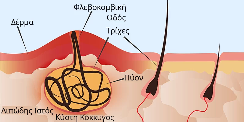 κύστη κόκκυγος | Πρωκτολόγος Θεσσαλονίκη Ιωάννης Παπαγιαννόπουλος